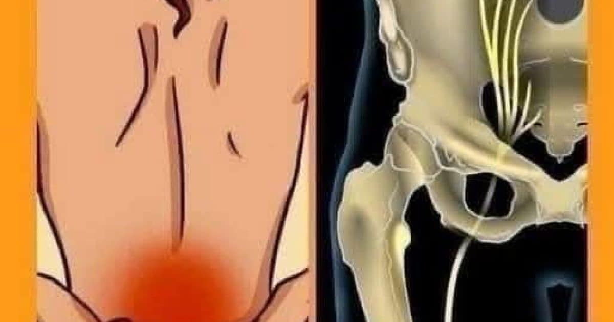 Remèdes naturels contre les maux de dos et la sciatique