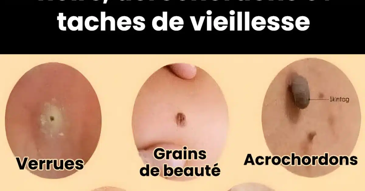 Remèdes naturels pour traiter les acrochordons, les verrues et les points noirs