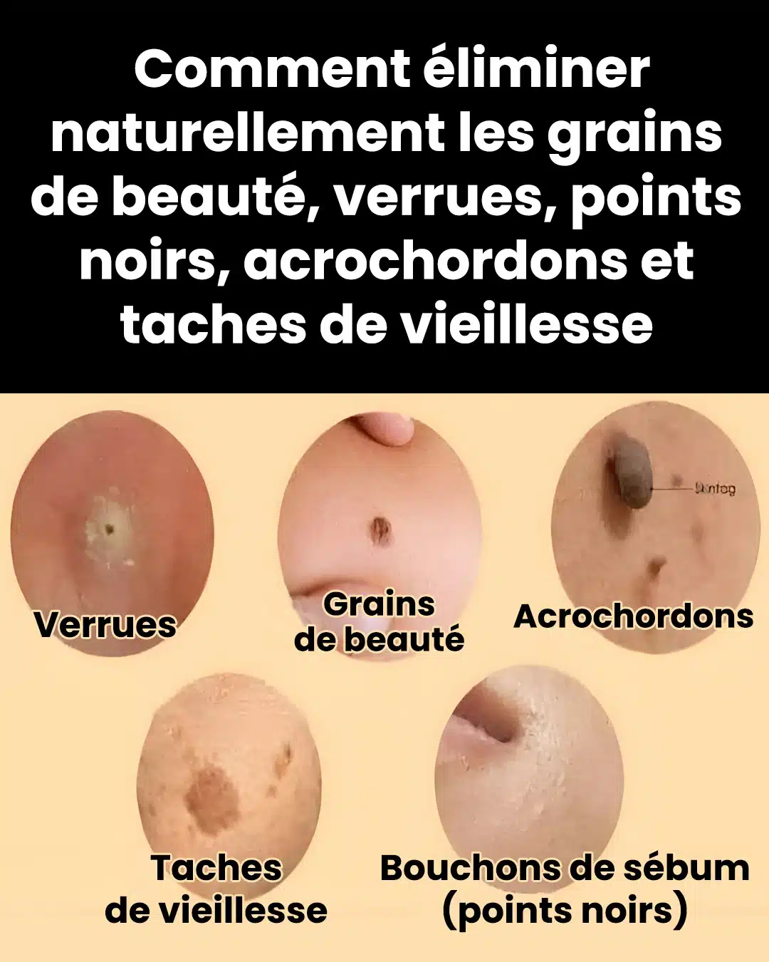 Remèdes naturels pour traiter les acrochordons, les verrues et les points noirs