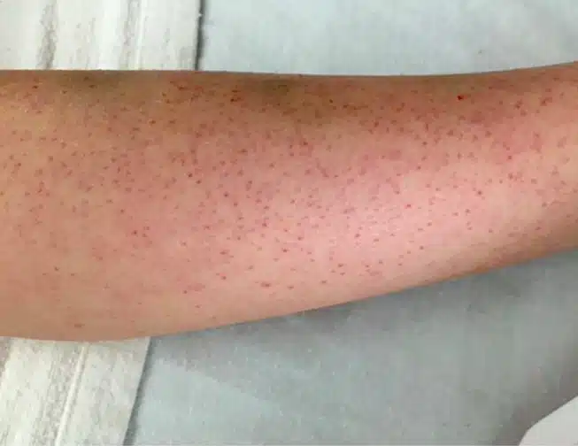 Différents types de taches rouges sur la peau