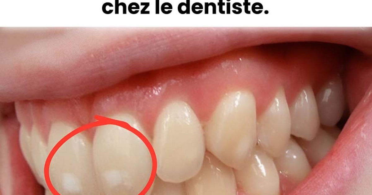 Si vos dents présentent des taches blanches comme celles-ci, prenez cette situation au sérieux