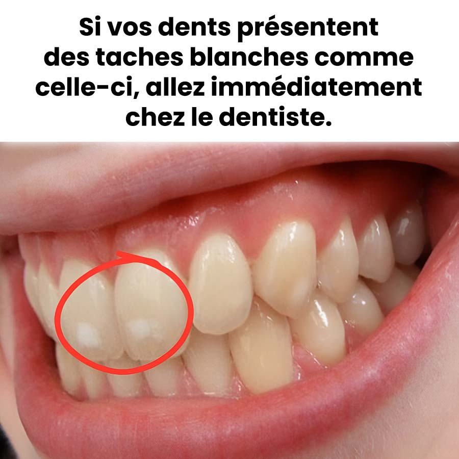 Si vos dents présentent des taches blanches comme celles-ci, prenez cette situation au sérieux