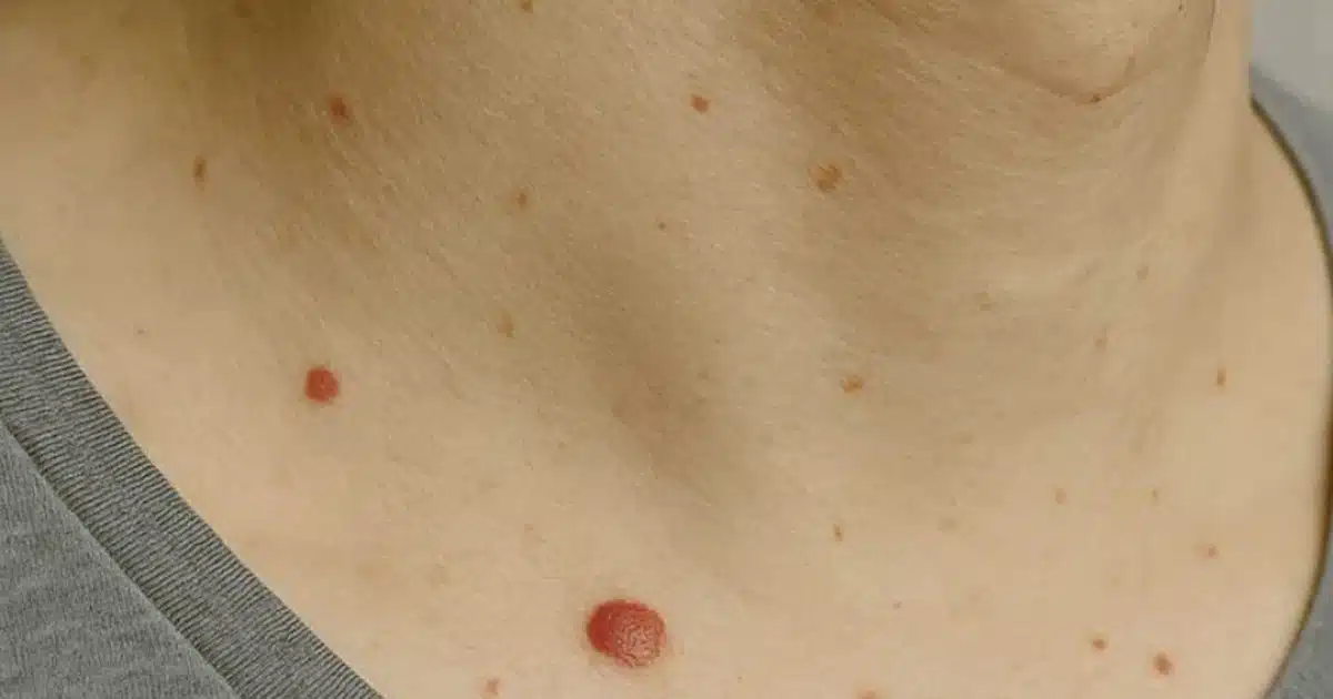 Si vous avez des grains de beauté rouges : quelles en est la signification ?