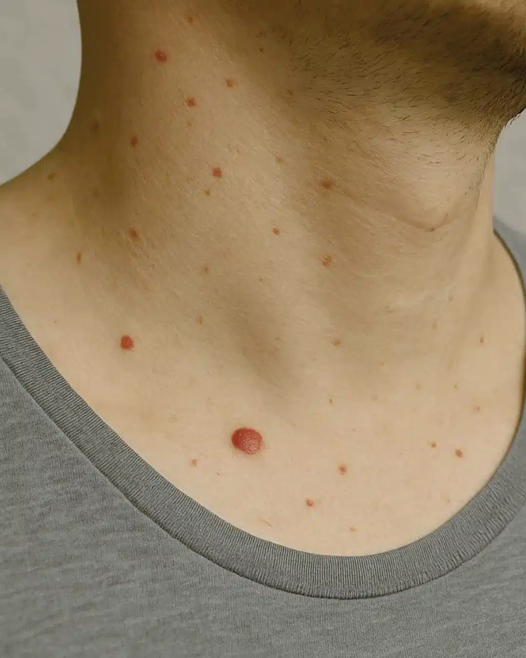 Si vous avez des grains de beauté rouges : quelles en est la signification ?