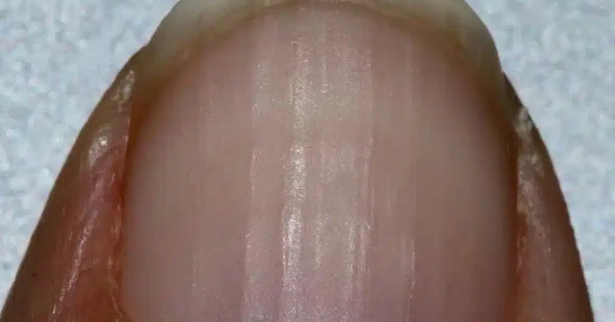 Si vous avez des stries sur les ongles, voici ce que cela dit de votre santé
