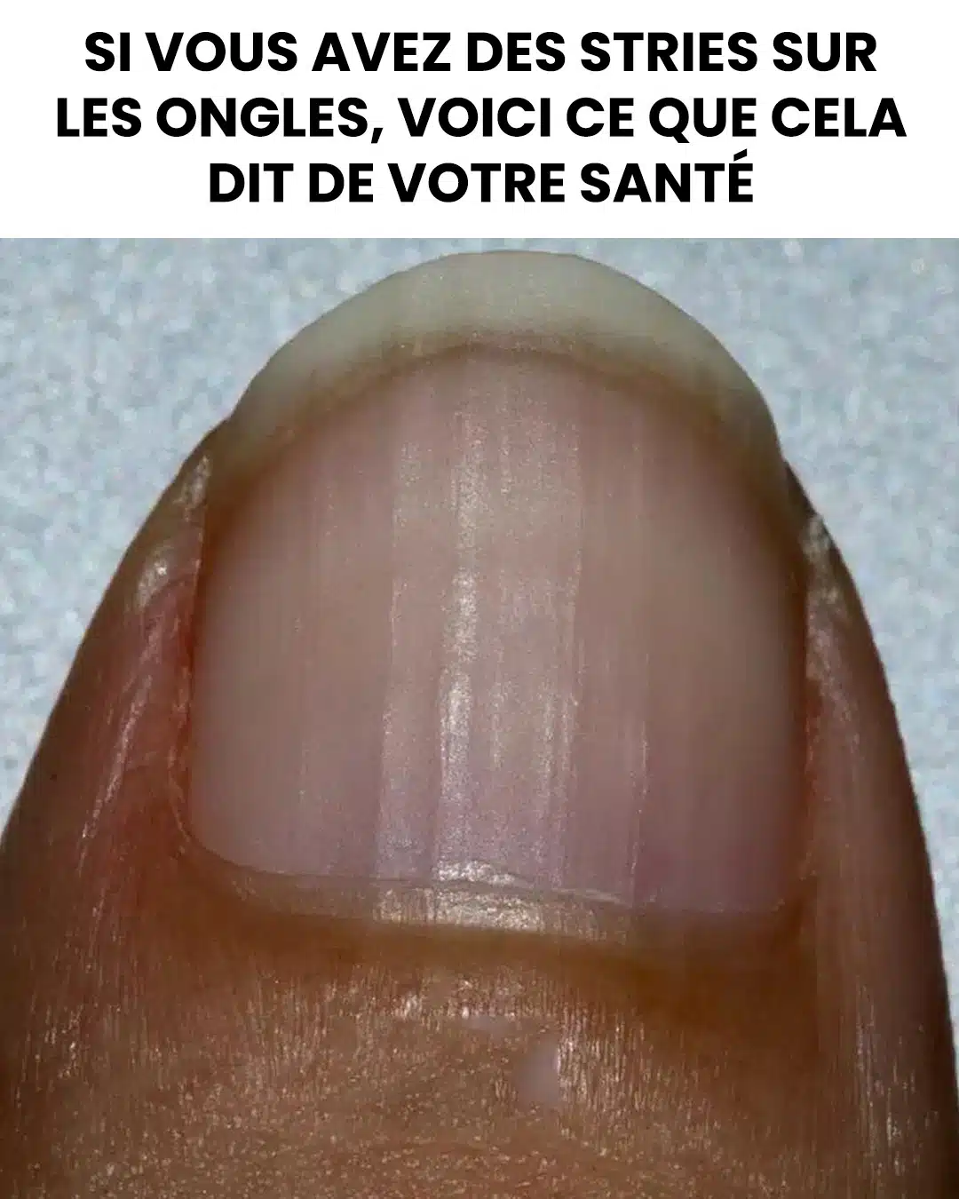 Si vous avez des stries sur les ongles, voici ce que cela dit de votre santé