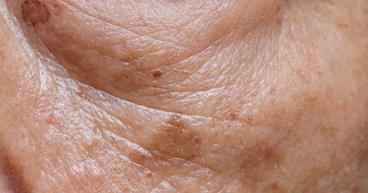 Si vous manquez de ce minéral, vous serez plus exposé au risque de développer des taches de vieillesse