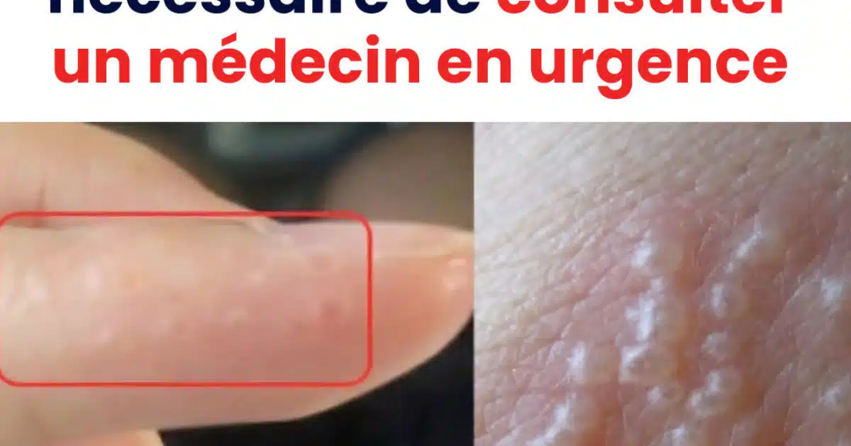 Si vous observez ces bosses rouges et douloureuses, il se pourrait que vous souffriez ce cette maladie