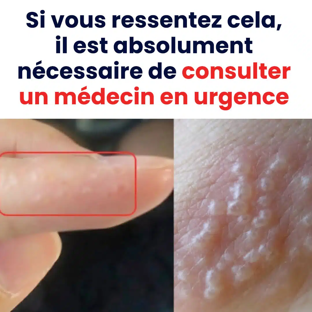 Si vous observez ces bosses rouges et douloureuses, il se pourrait que vous souffriez ce cette maladie