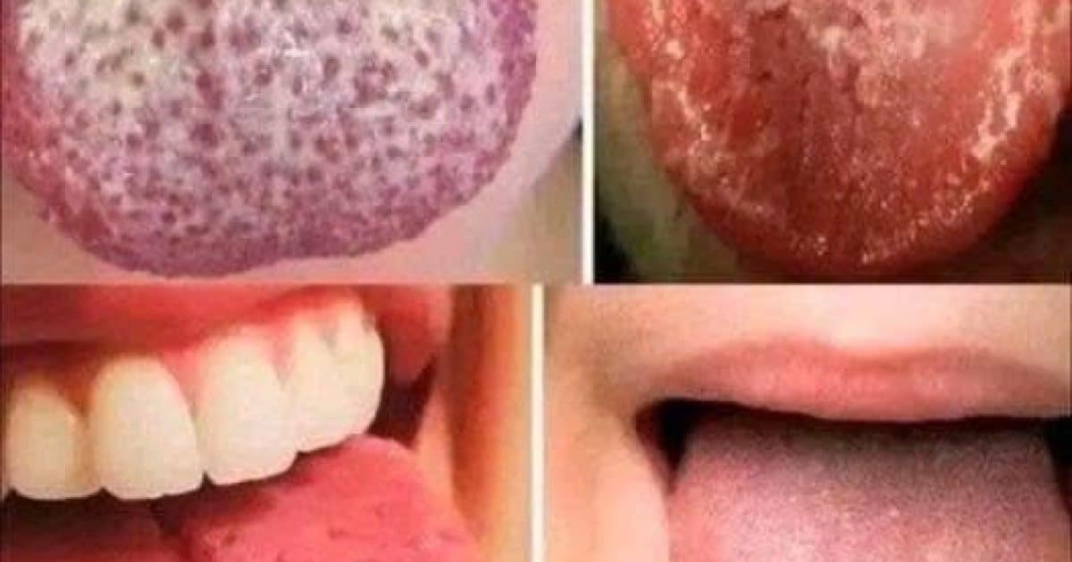 Si vous présentez ces quatre symptômes sur la langue, ils pourraient indiquer des problèmes de santé sous-jacents