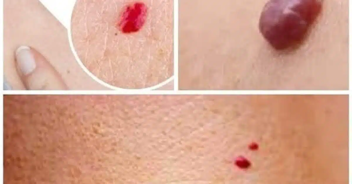 Si vous remarquez ces points rouges sur votre peau, voici ce qu’ils signifient