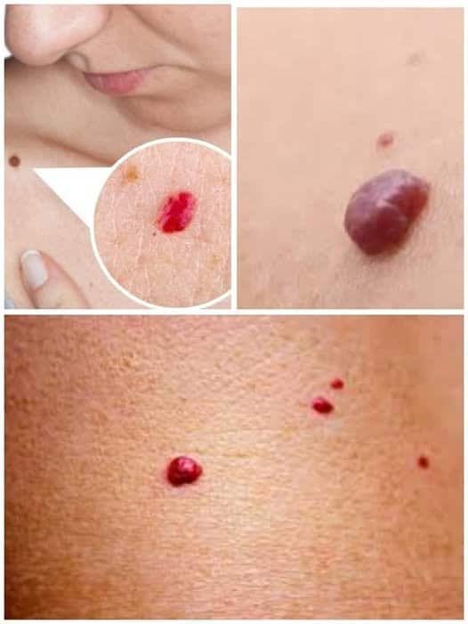 Si vous remarquez ces points rouges sur votre peau, voici ce qu’ils signifient