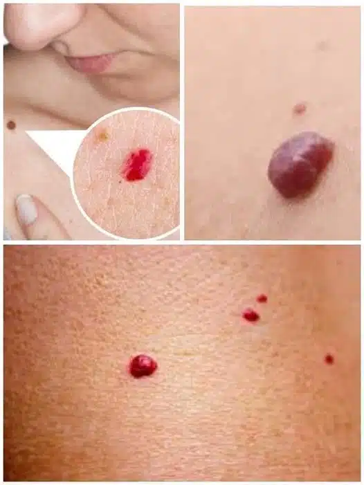 Si vous remarquez ces points rouges sur votre peau, voici ce qu’ils signifient
