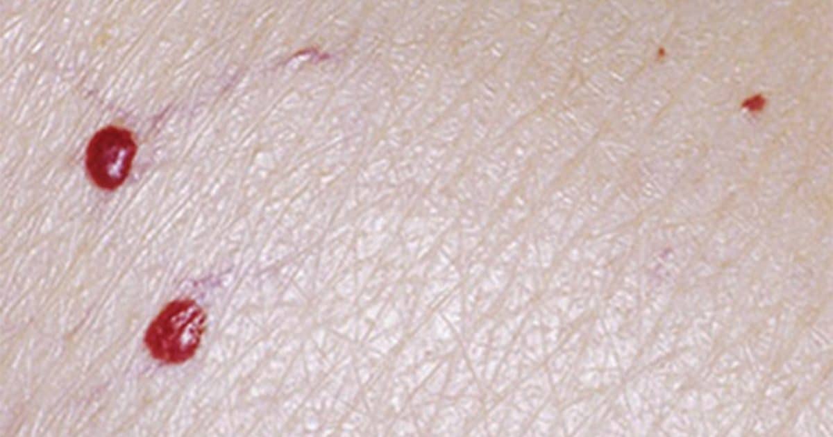 Taches rouges sur la peau : quelles significations ?