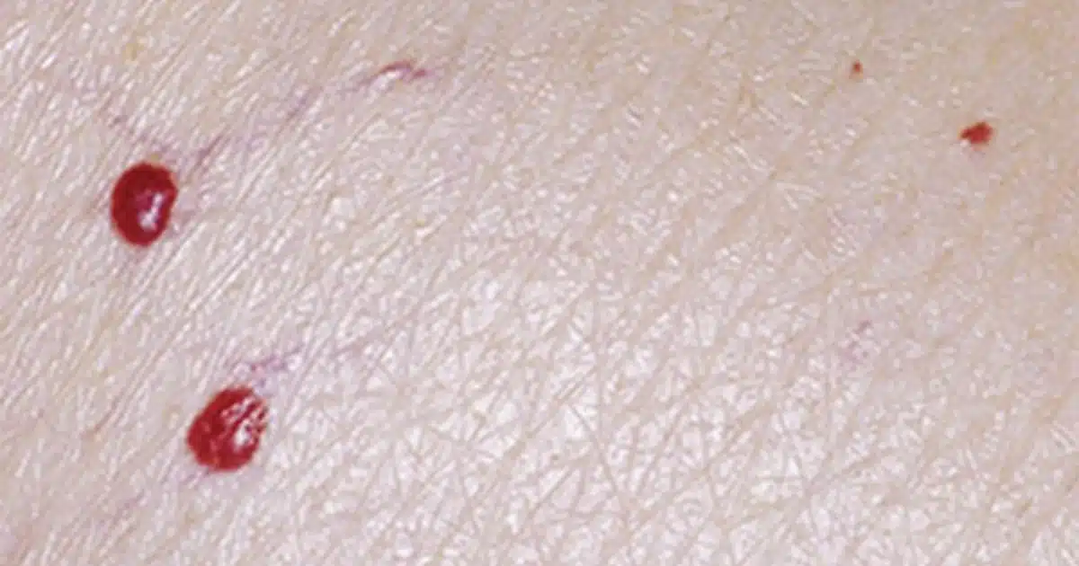 Taches rouges sur la peau : quelles significations ?