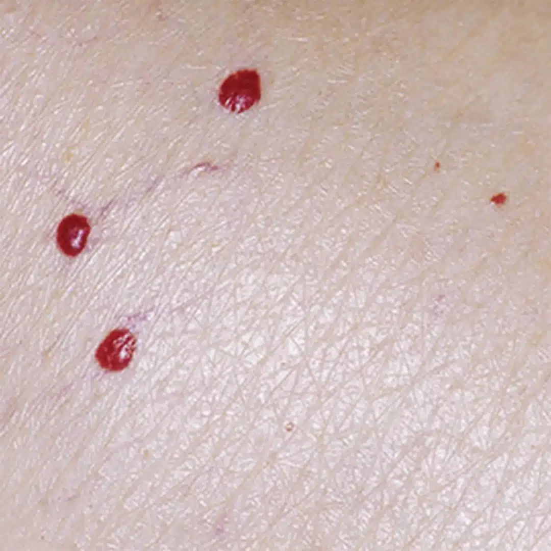 Taches rouges sur la peau : quelles significations ?