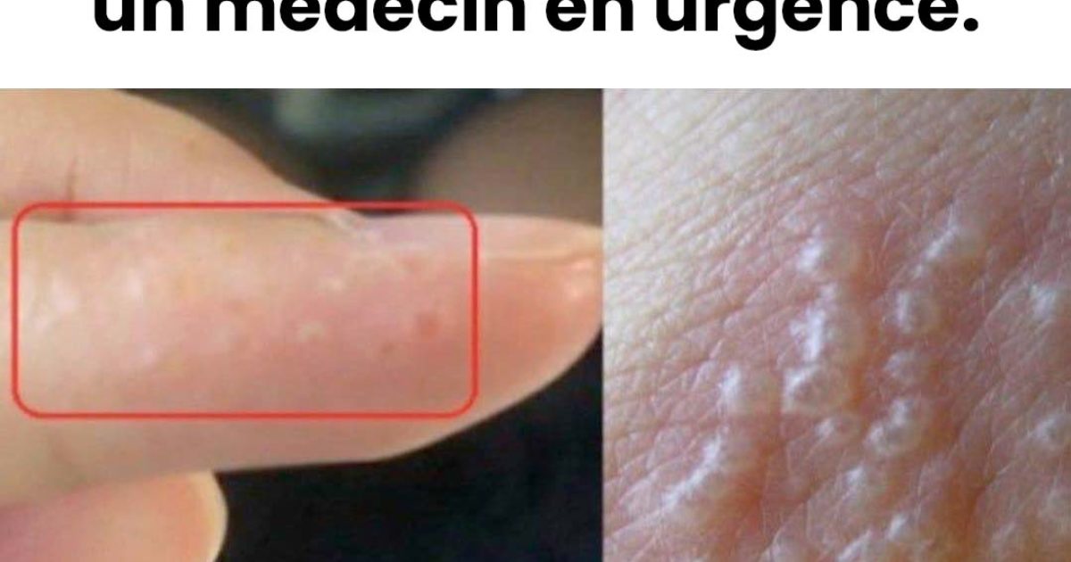 Tout savoir sur l'eczéma dyshidrosique