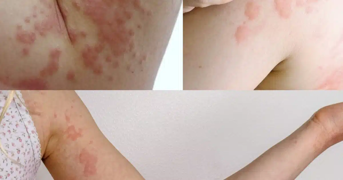 Tout son corps la démangeait : ce qu’elle pensait être une simple allergie cachait quelque chose d'autre