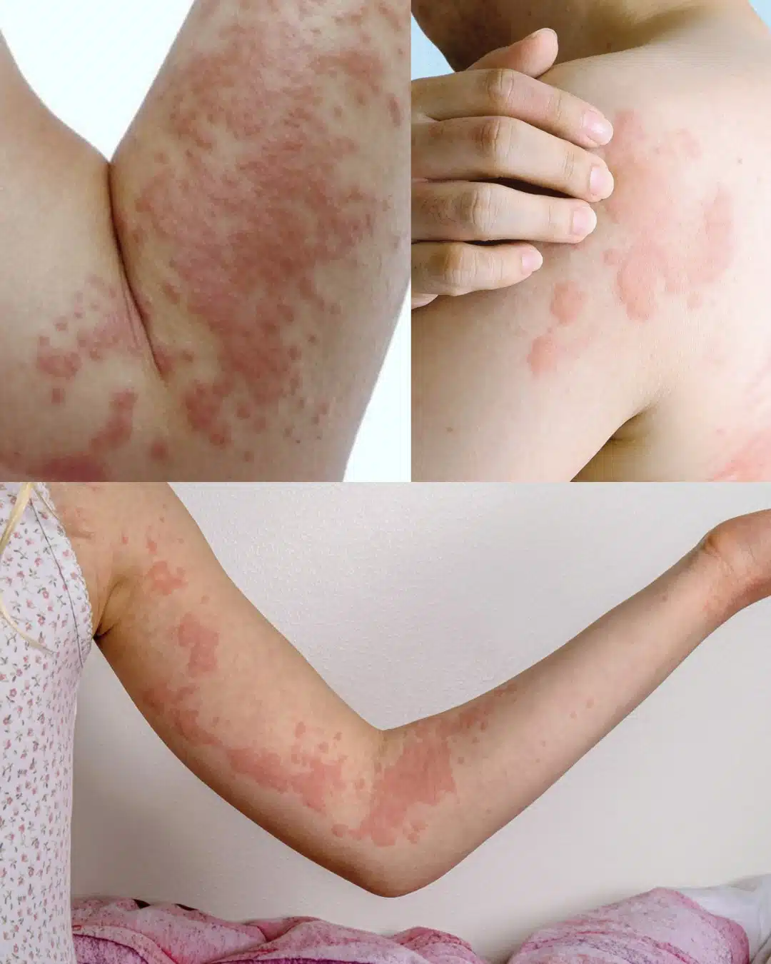 Tout son corps la démangeait : ce qu’elle pensait être une simple allergie cachait quelque chose d'autre