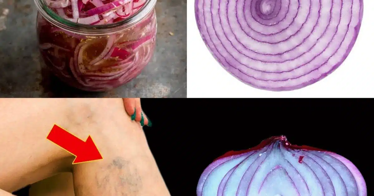 Transformez vos jambes naturellement avec l’oignon rouge : une astuce contre les varices