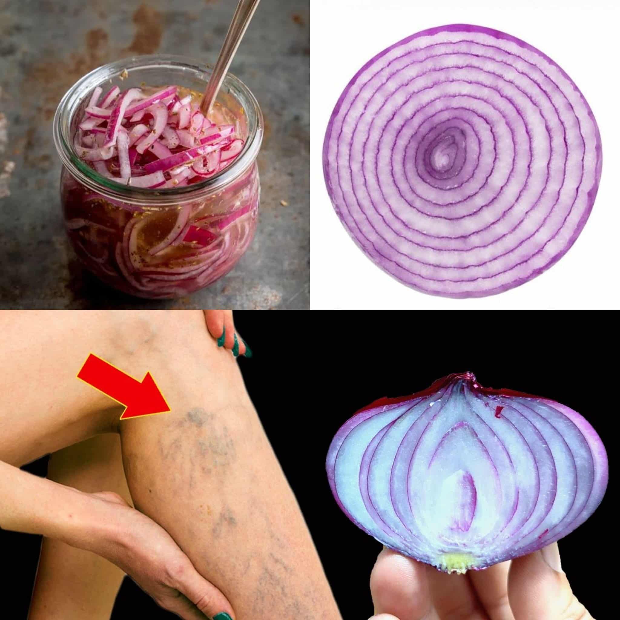 Transformez vos jambes naturellement avec l’oignon rouge : une astuce contre les varices
