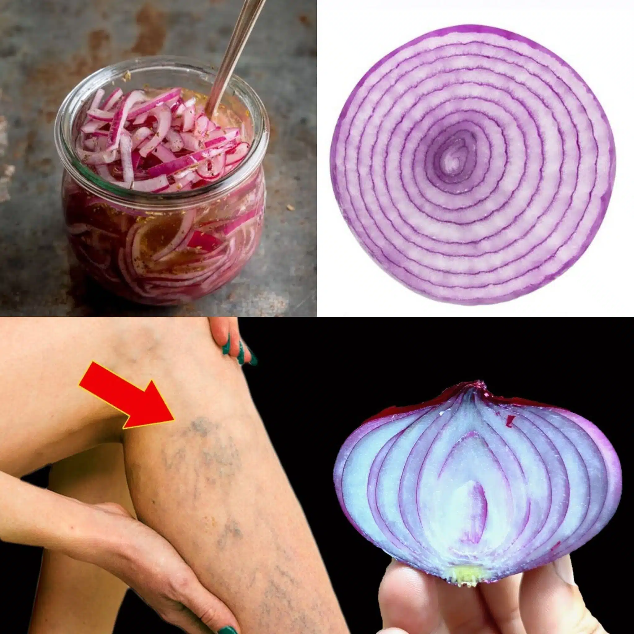 Transformez vos jambes naturellement avec l’oignon rouge : une astuce contre les varices