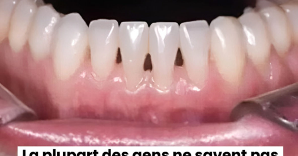 Un dentiste explique ce que signifie avoir des triangles noirs entre les dents