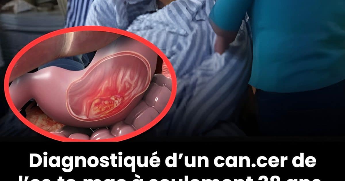 Un homme de 38 ans atteint d'un cancer de l'estomac met en garde : 3 aliments qu’il vaut mieux éviter