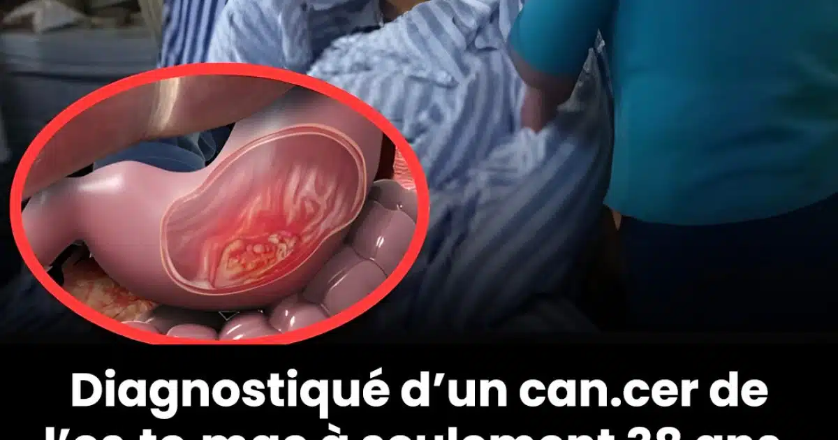 Un homme de 38 ans atteint d'un cancer de l'estomac met en garde : 3 aliments qu’il vaut mieux éviter