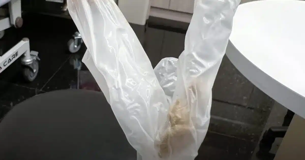 Un médecin découvre une accumulation de smegma depuis 30 ans sous le prépuce d'un homme marié qui souffrait de douleurs atroces