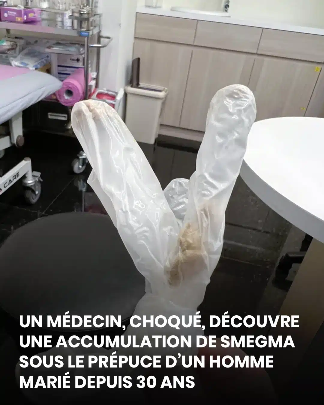 Un médecin découvre une accumulation de smegma depuis 30 ans sous le prépuce d'un homme marié qui souffrait de douleurs atroces