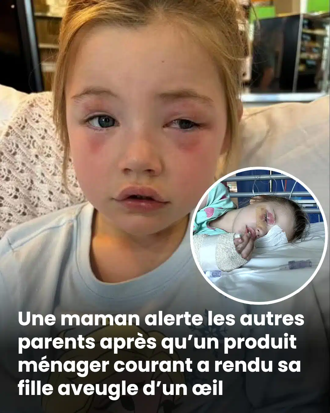 Un produit ménager courant rend une petite fille "aveugle d'un œil"