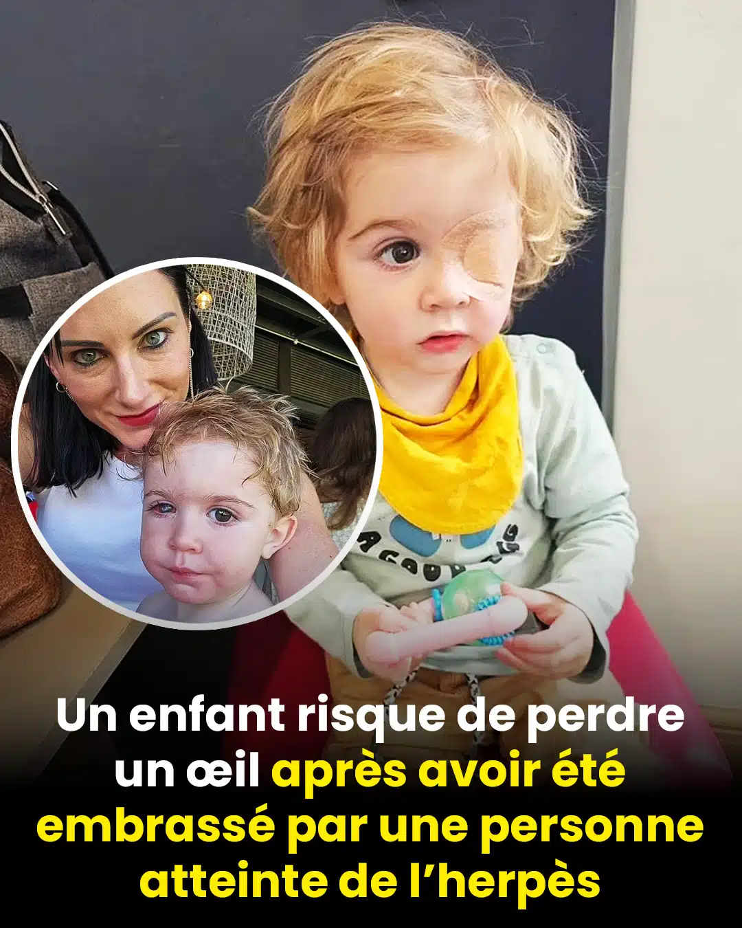 Un tout-petit risque de perdre un œil après avoir été embrassé par une personne ayant un bouton de fièvre