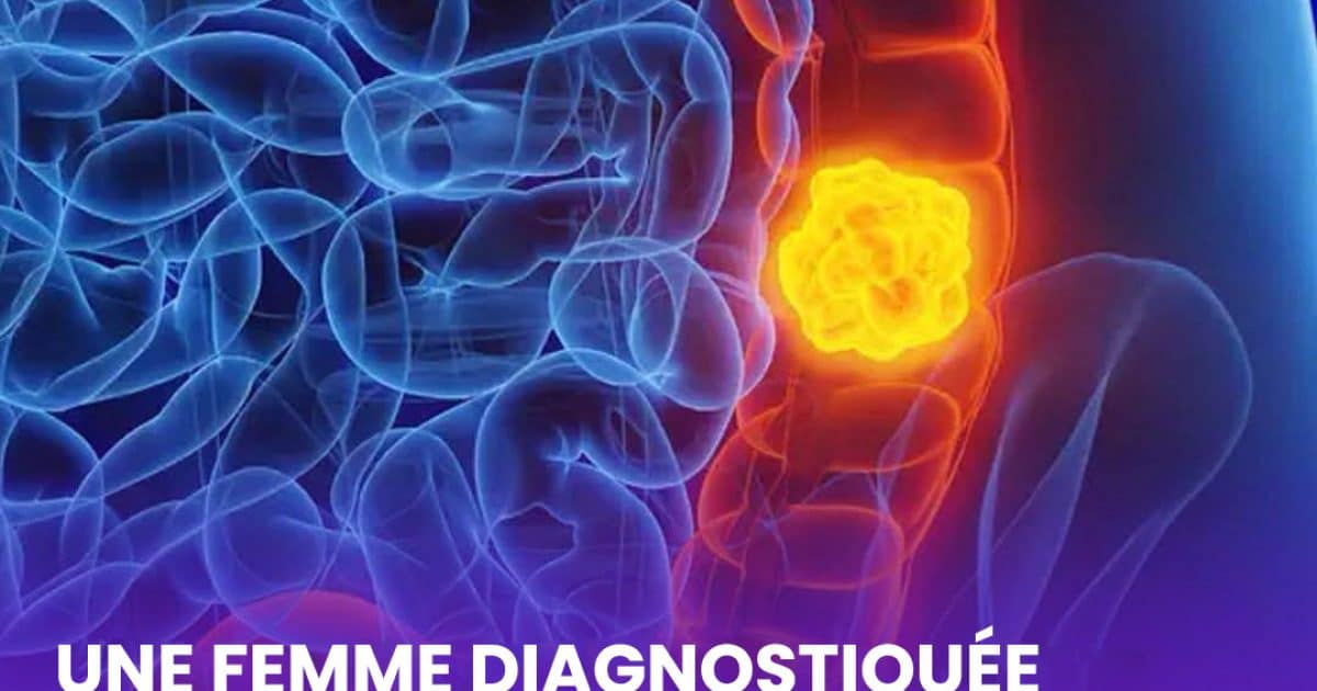 Une femme révèle cinq symptômes du cancer du côlon qu’il ne faut pas ignorer