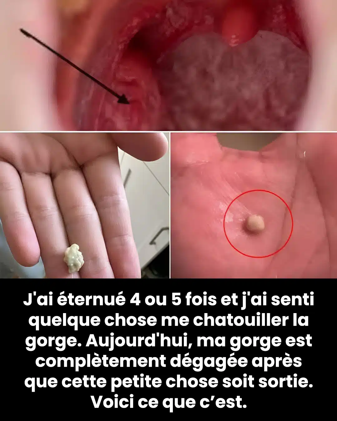 Voici ce que vous devez savoir sur les calculs amygdaliens