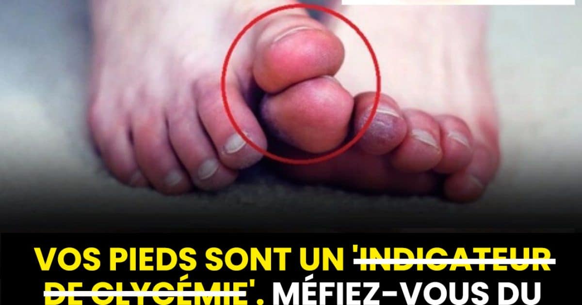 Voici cinq symptômes inhabituels de haute glycémie à identifier au niveau des pieds