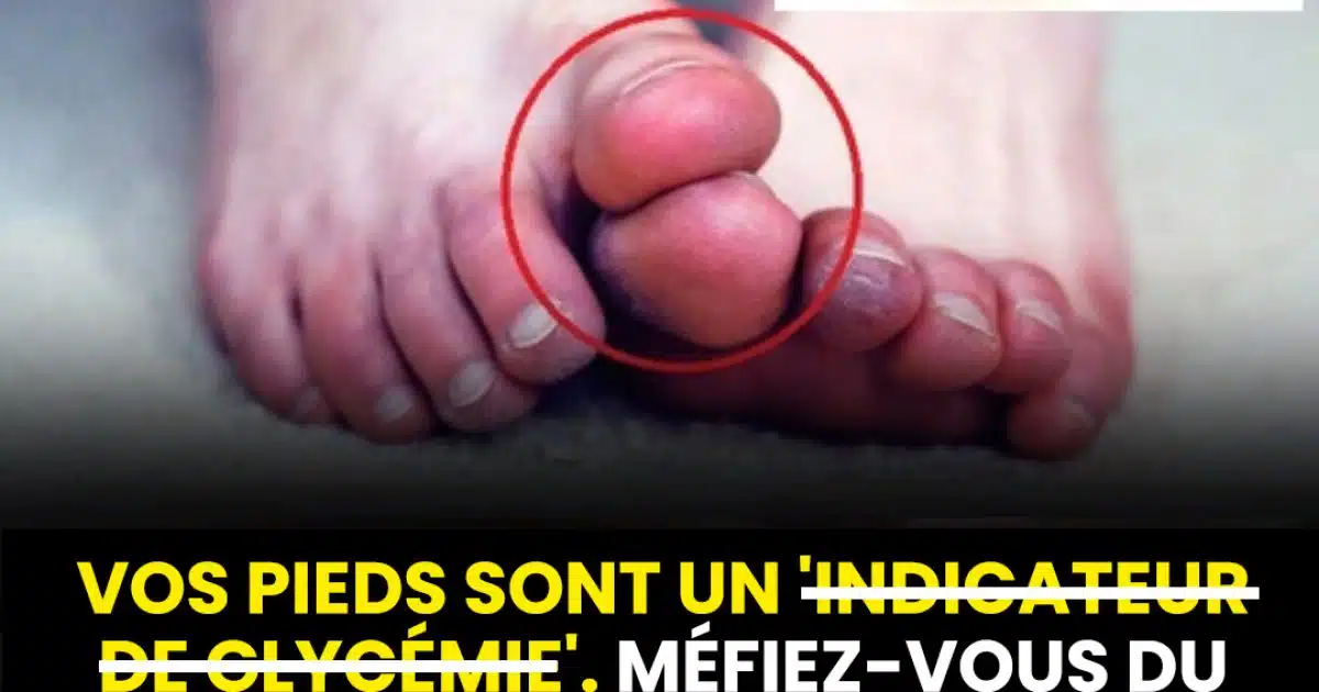 Voici cinq symptômes inhabituels de haute glycémie à identifier au niveau des pieds