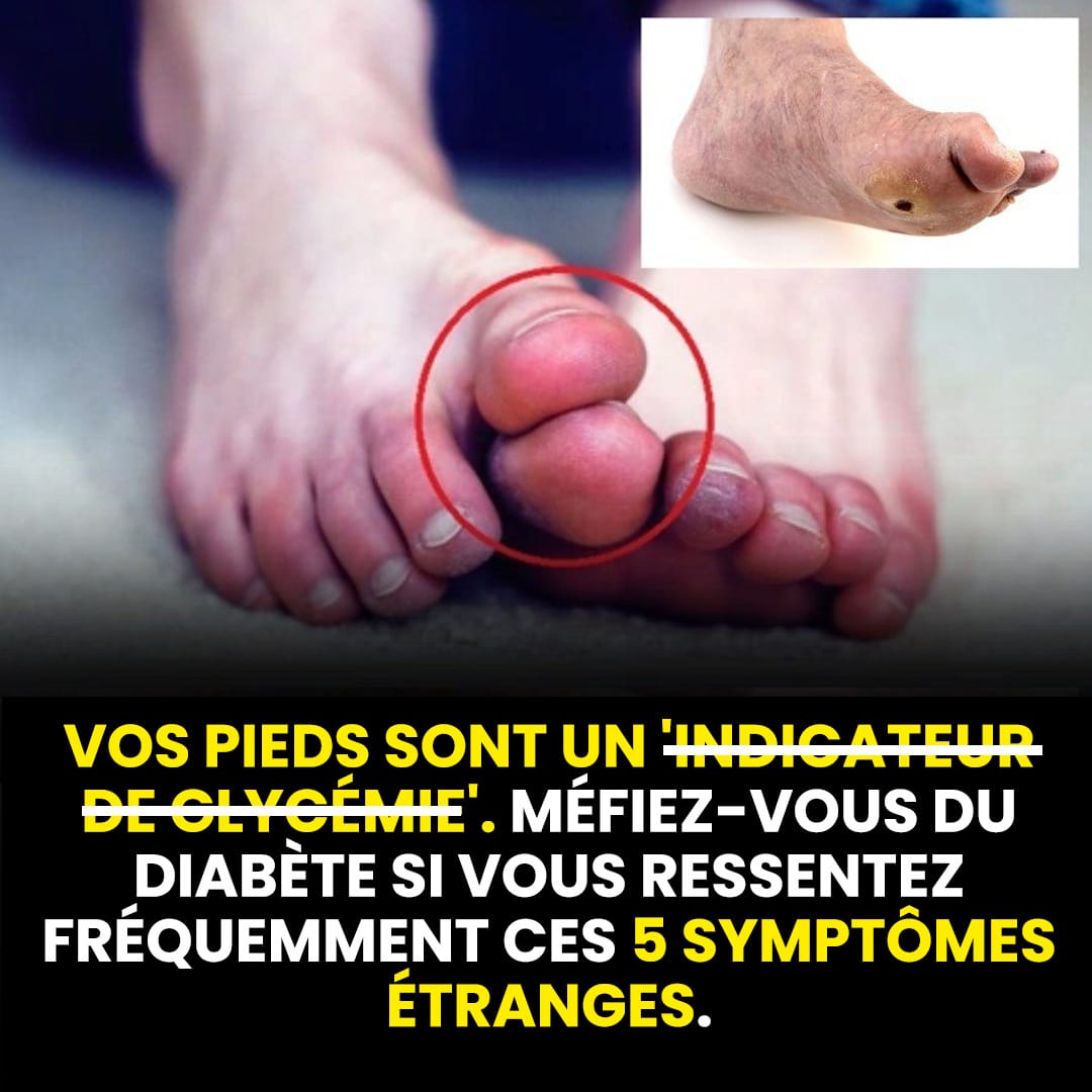 Voici cinq symptômes inhabituels de haute glycémie à identifier au niveau des pieds