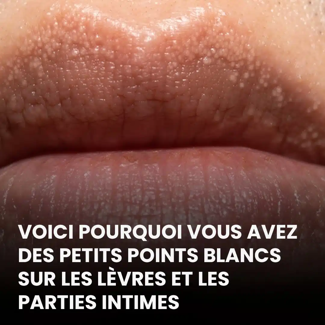Voici pourquoi vous avez des petits points blancs sur les lèvres et les parties intimes