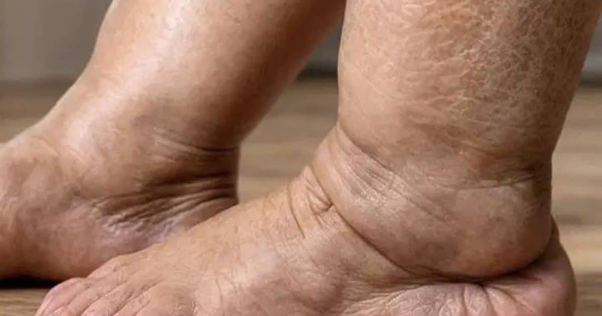 Vous avez les jambes lourdes, des picotements ou des crampes fréquentes ? Ce qu’il faut savoir
