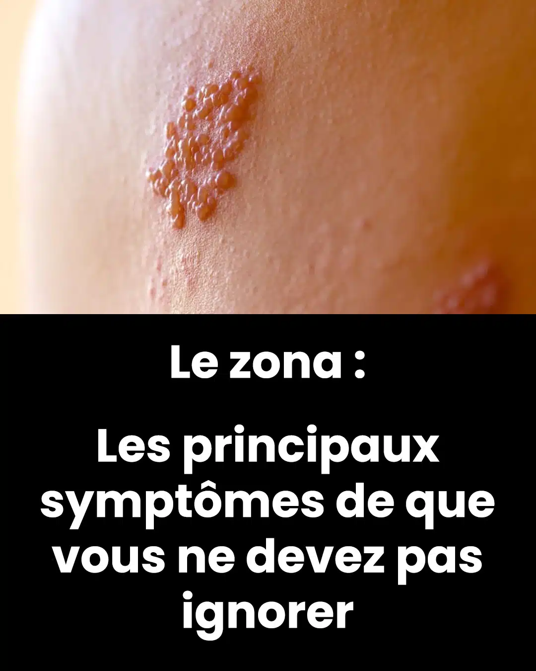 Zona : symptômes, complications et prévention