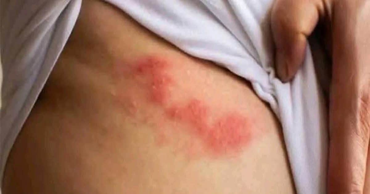 Zona : une douleur virale méconnue, mais évitable après 50 ans