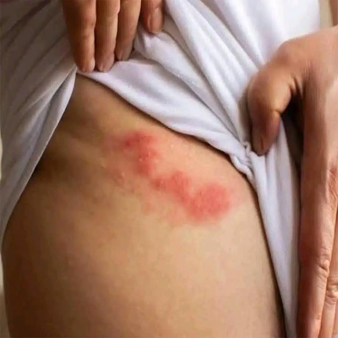 Zona : une douleur virale méconnue, mais évitable après 50 ans